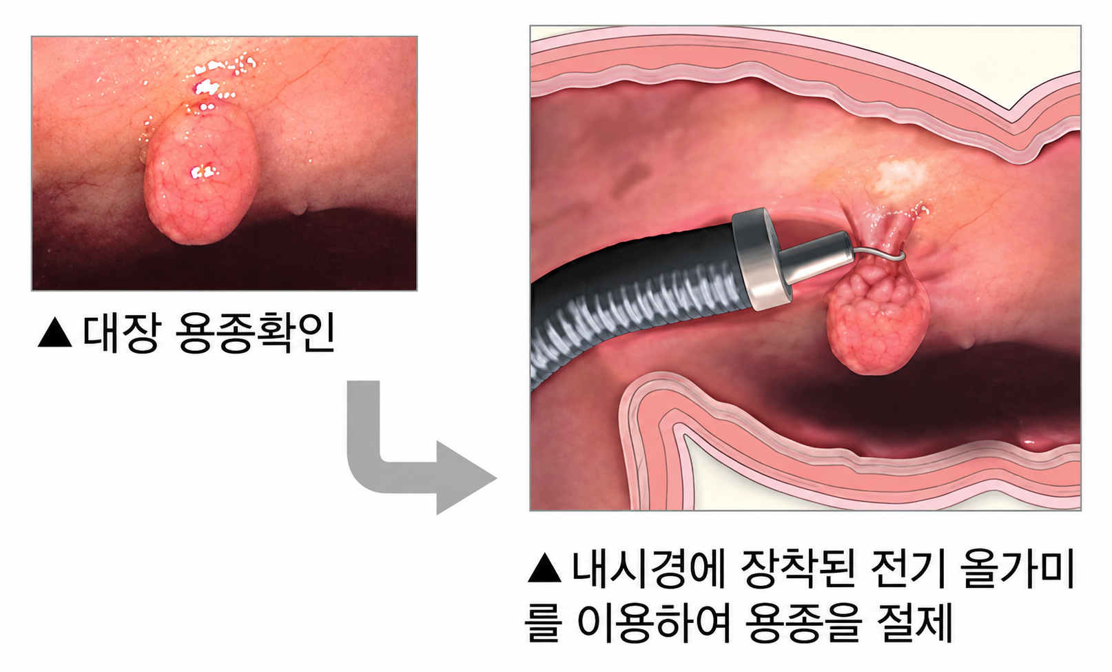 대장 용종확인 및 내시경에 장착된 전기 올가미를 이용하여 용종을 절제